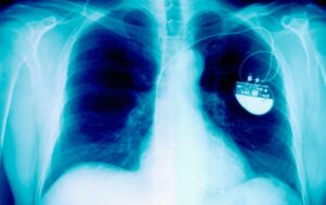 New pacemaker completely changes the functioning of a failing heart, Oxford scientists reveal