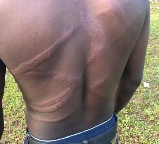 Back view of a shirtless person with several long horizontal scars on the upper back, outdoors on grass.