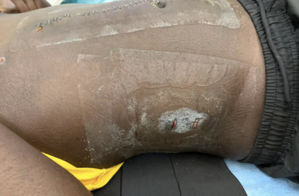 Close-up of a dark-skinned knee with a healing surgical incision and stitches.