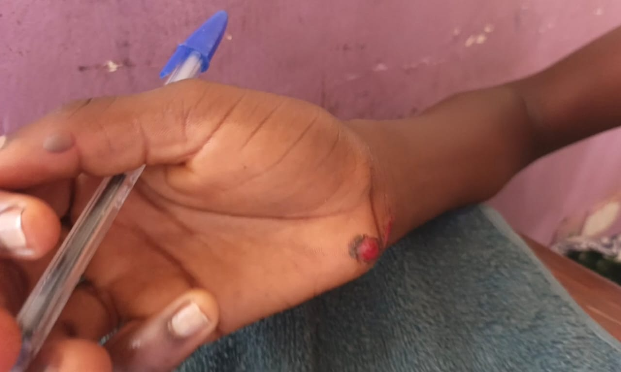 Close-up of a dark-skinned hand with a small red wound on the palm near the base of the thumb, and a blue pen held nearby.