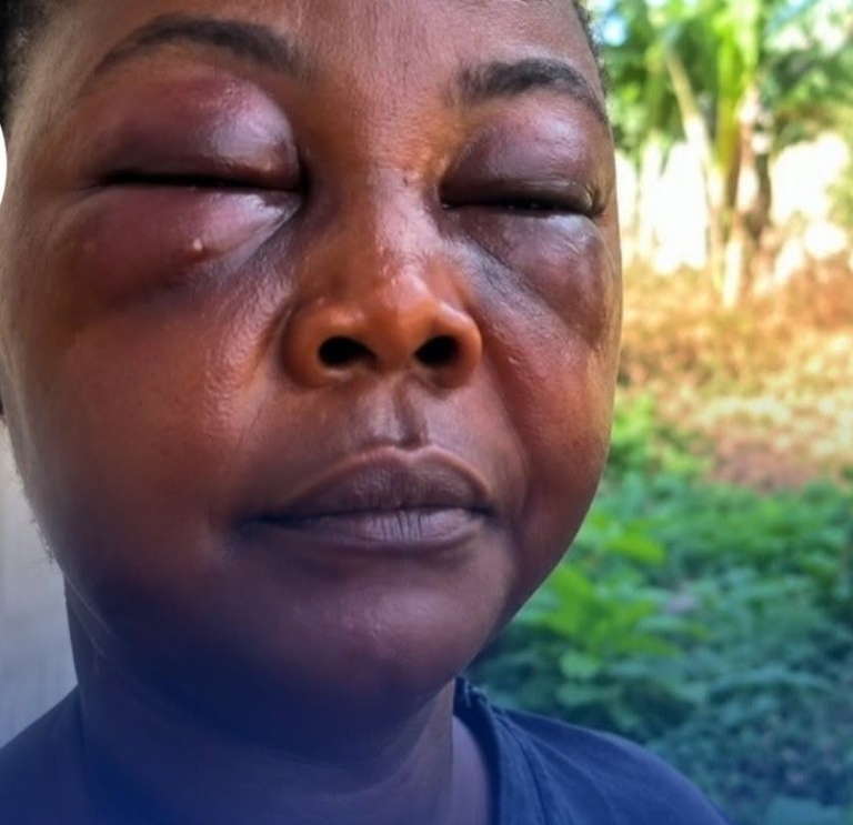 Close-up of a person with a swollen, bruised eye and closed eyelids outdoors.