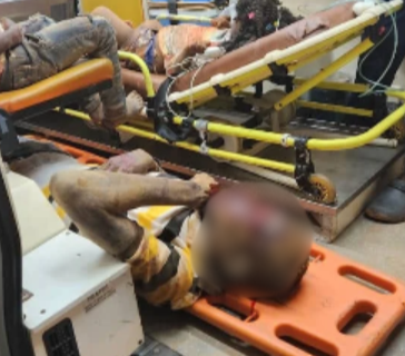Injured person with head injury on an orange spine board, face blurred, surrounded by yellow ambulance gurney rails and responders in a medical setting.